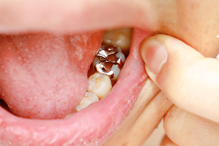 銀歯や金属の使用で起こるリスク