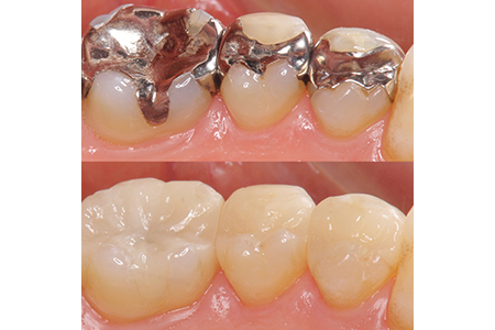 保険診療で実現できる白い歯