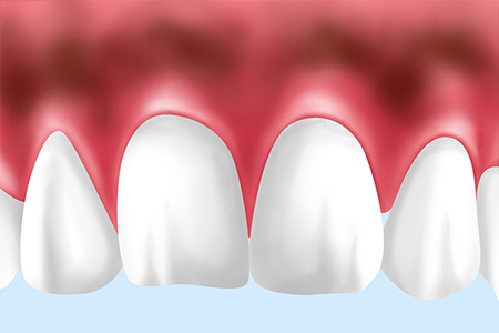 歯科用レーザーによる歯ぐきの黒ずみの除去