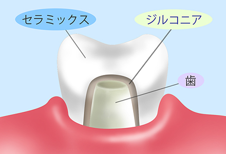 ジルコニアボンド