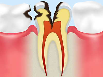 C3 神経にまでおよんだ虫歯