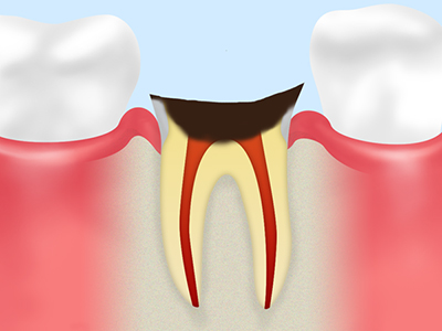 C4 歯根にまでおよんだ虫歯