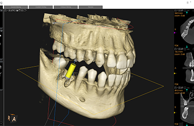 歯科用CTによる精密な診査・診断