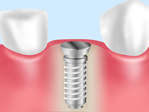インプラントと骨が結合するまで待つ