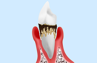 重度歯周炎